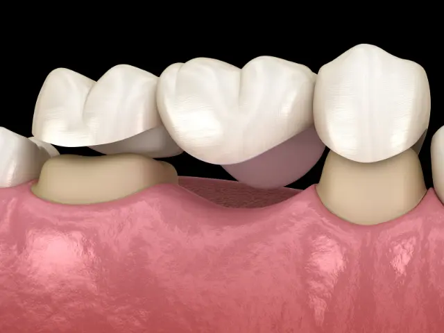 dental bridges loughborough