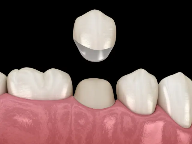 dental crowns loughborough