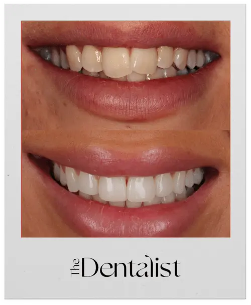 composite bonding loughborough - before and after photo taken at the dentalist 1